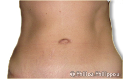 Abdominoplasty After