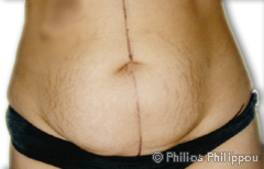 Abdominoplasty Before