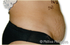 Abdominoplasty Before