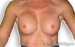 Breast Enlargement After Breast Enlargement After