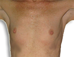 Breast Enlargement Before Breast Enlargement Before