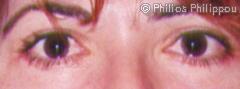 Eyelid Reduction After