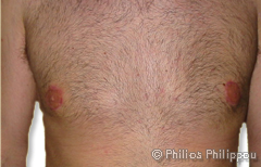 Gynaecomastia After