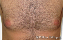 Gynaecomastia Before