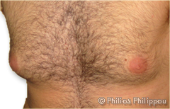 Gynaecomastia Before