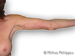 Left Arm Brachioplasty After