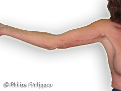Right Arm Brachioplasty After